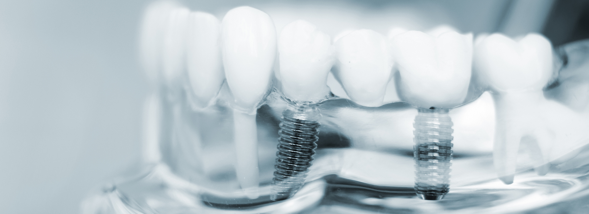 Bay Ridge Dental | Dental Cleanings, Invisalign reg  and Teeth Whitening